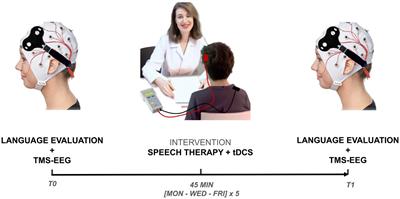 Transcranial direct current stimulation combined with speech therapy in Fragile X syndrome patients: a pilot study